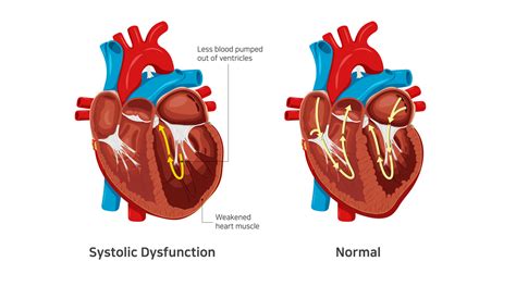 lv systolic dysfunction.